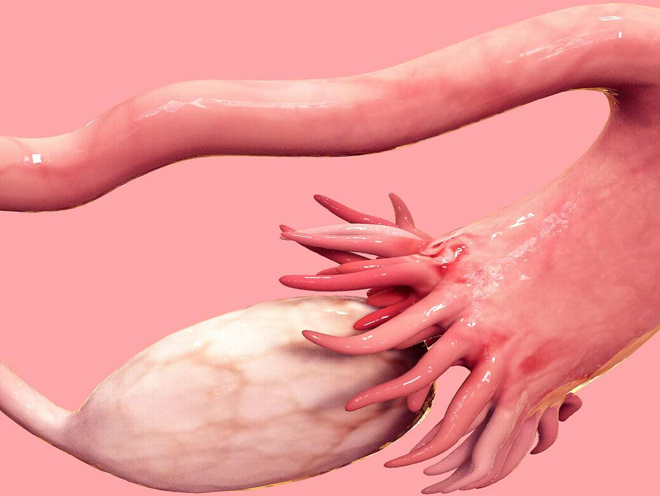 Hidrosalpinx, ¿qué es y cómo se diagnostica?