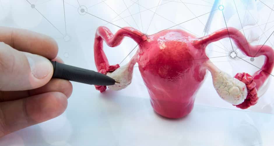 Qué debo hacer si tengo ovario poliquístico y quiero embarazarme